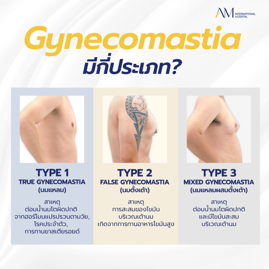 gynecomastia type