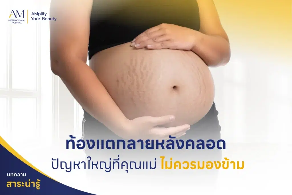 ท้องแตกลาย