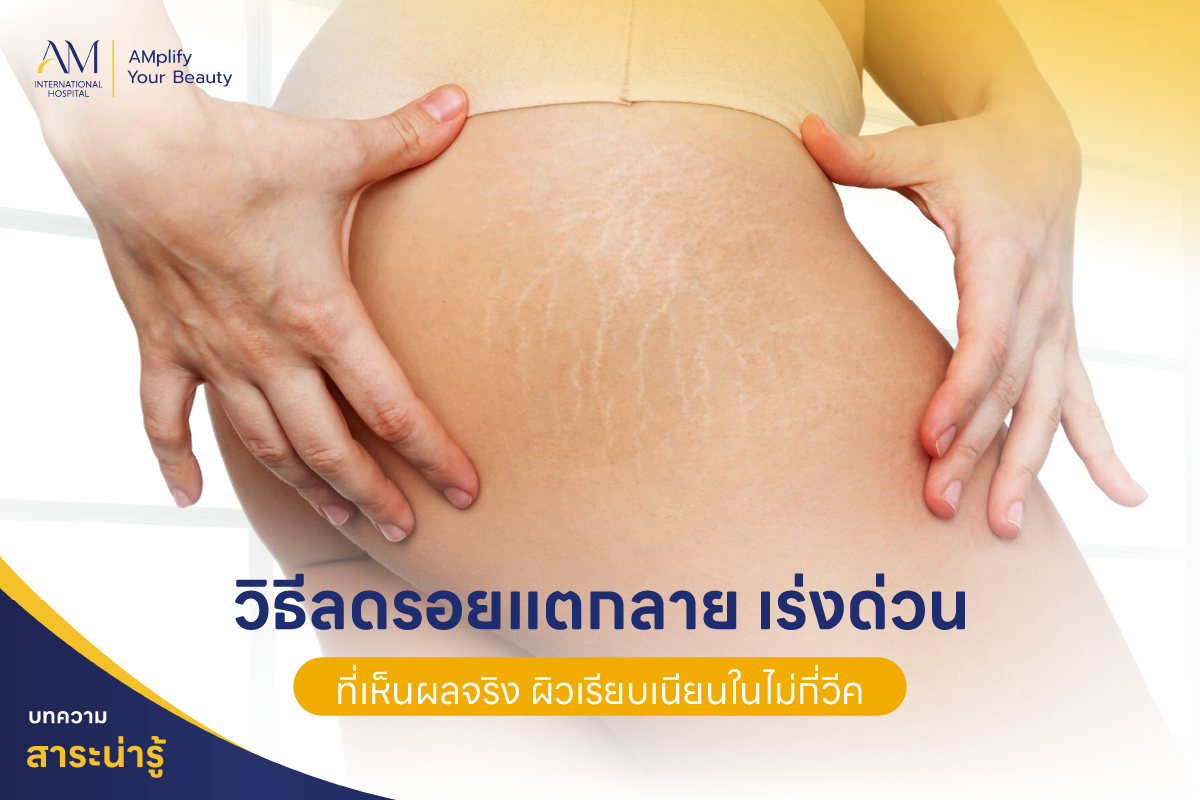 วิธีลดรอยแตกลายเร่งด่วน