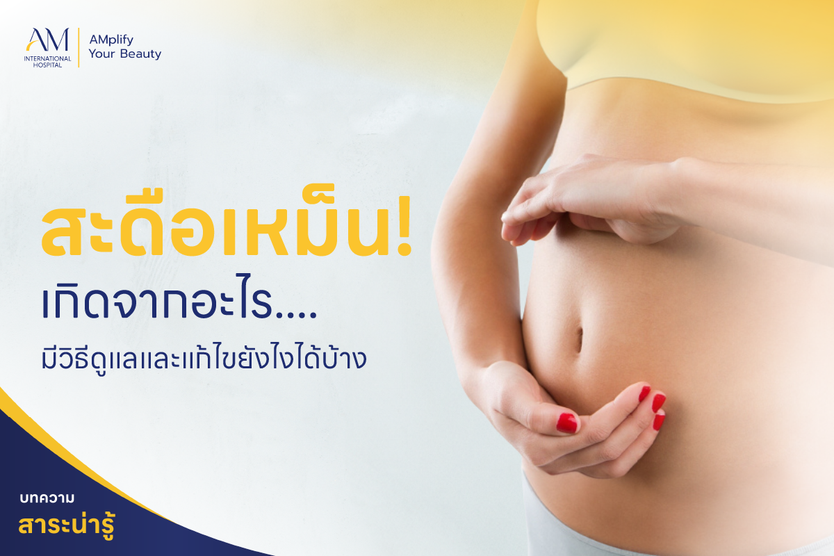 สะดือเหม็น
