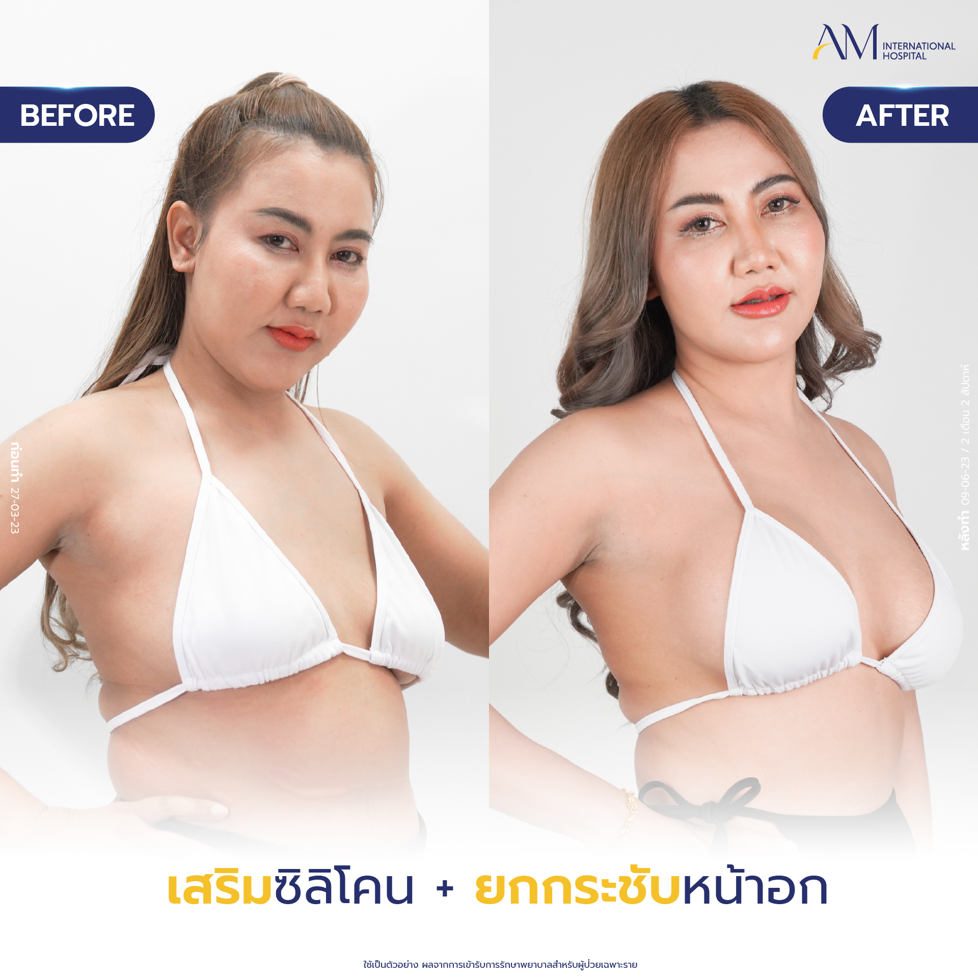 20250618-Consi-Album-BA_Line_Breast Lift 2025-01