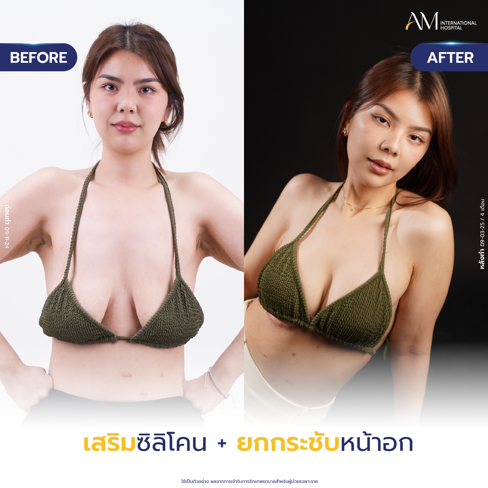 20250618-Consi-Album-BA_Line_Breast Lift 2025-02