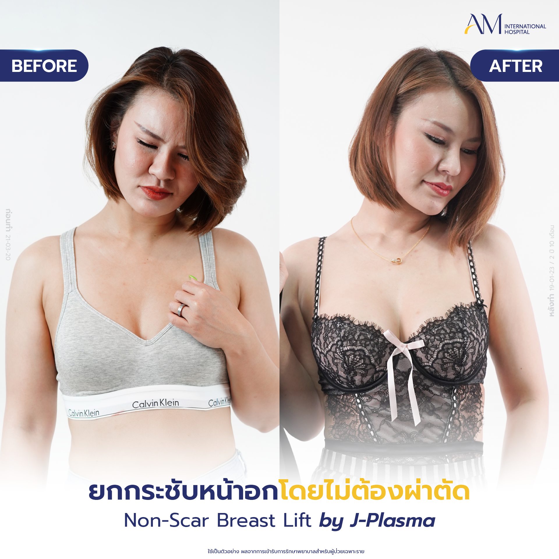 20250618-Consi-Album-BA_Line_Breast Lift 2025-04