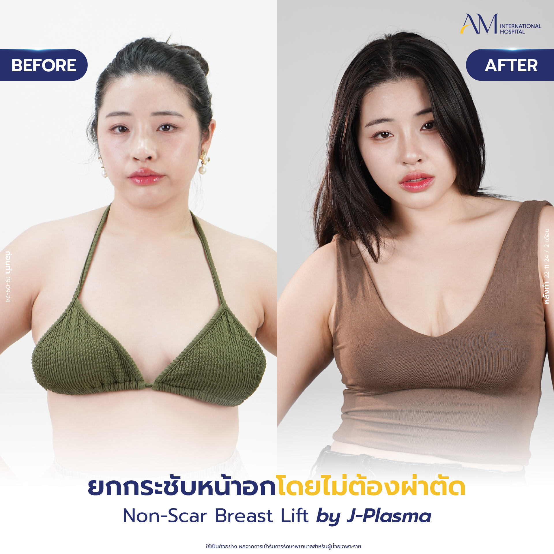 20250618-Consi-Album-BA_Line_Breast Lift 2025-06
