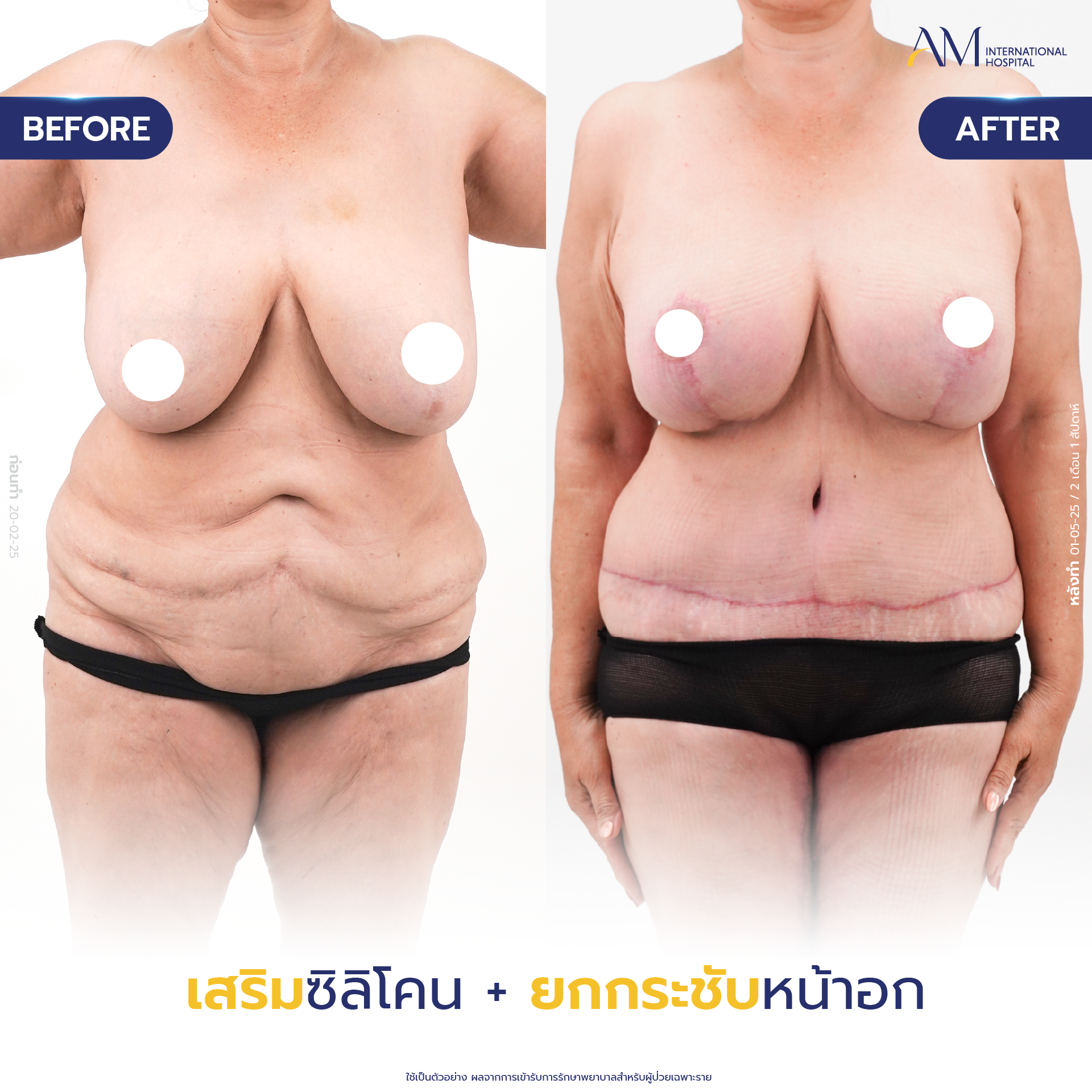 20250618-Consi-Album-BA_Line_Breast Lift 2025-07