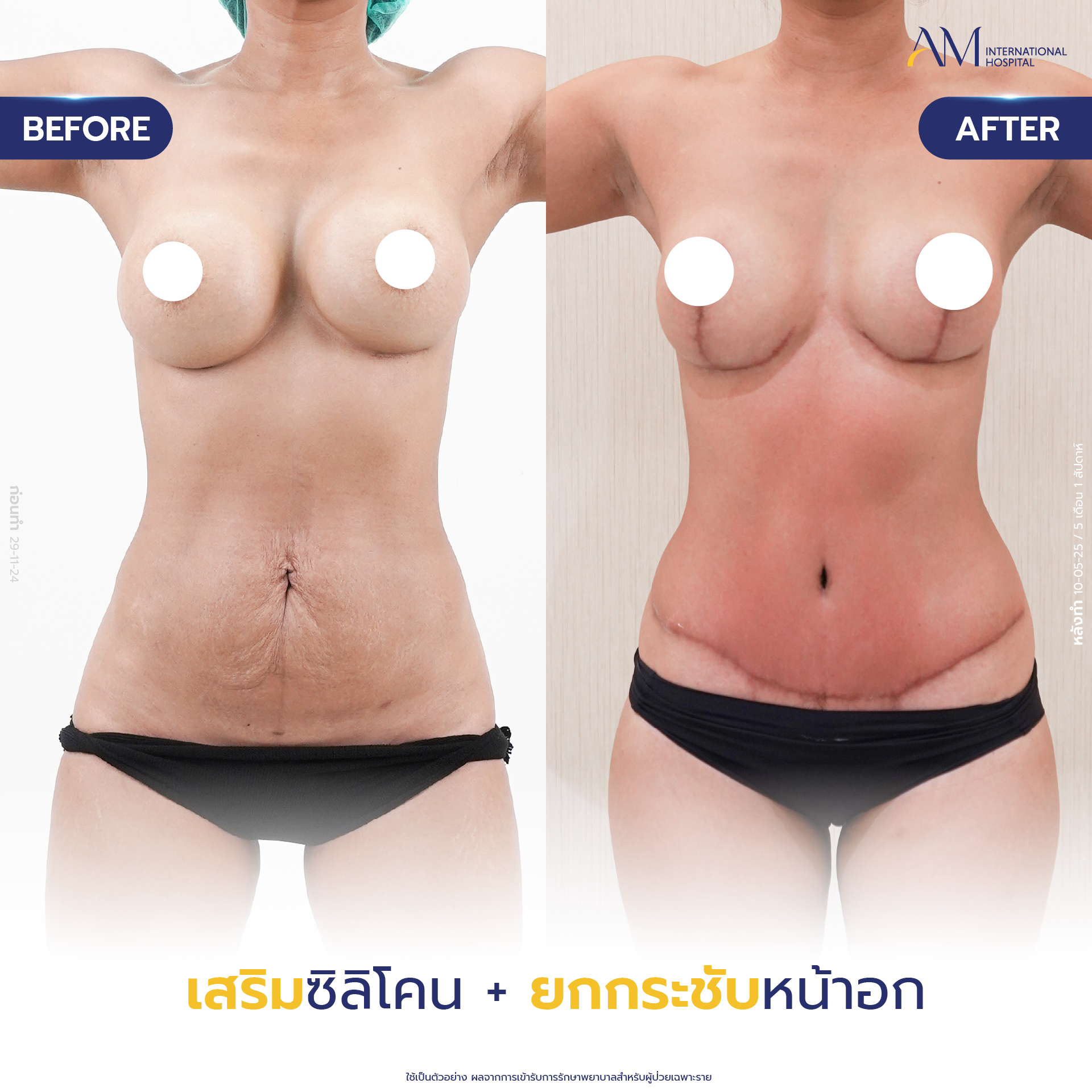 20250618-Consi-Album-BA_Line_Breast Lift 2025-09