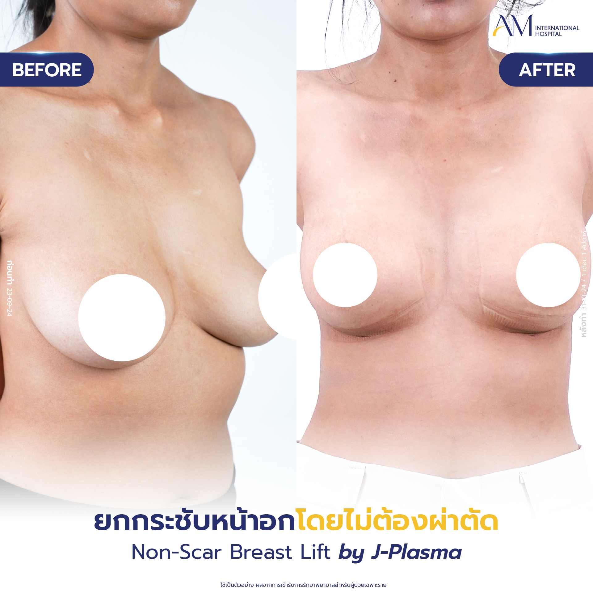 20250618-Consi-Album-BA_Line_Breast Lift 2025-10