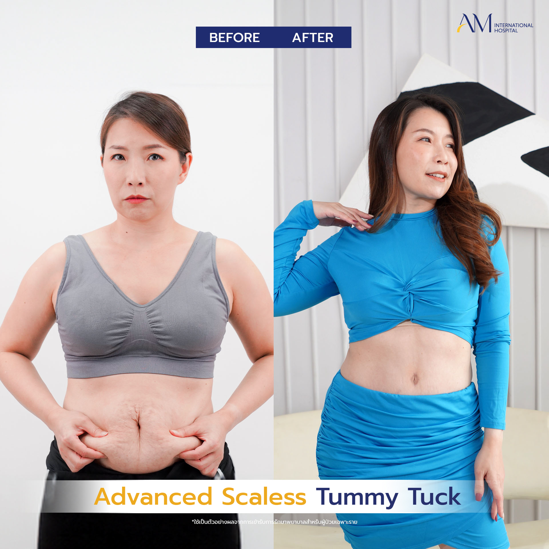 20250619-consi-single-BA_Line_Tummy Tuck 2025(แบบไม่มีแสง)-04