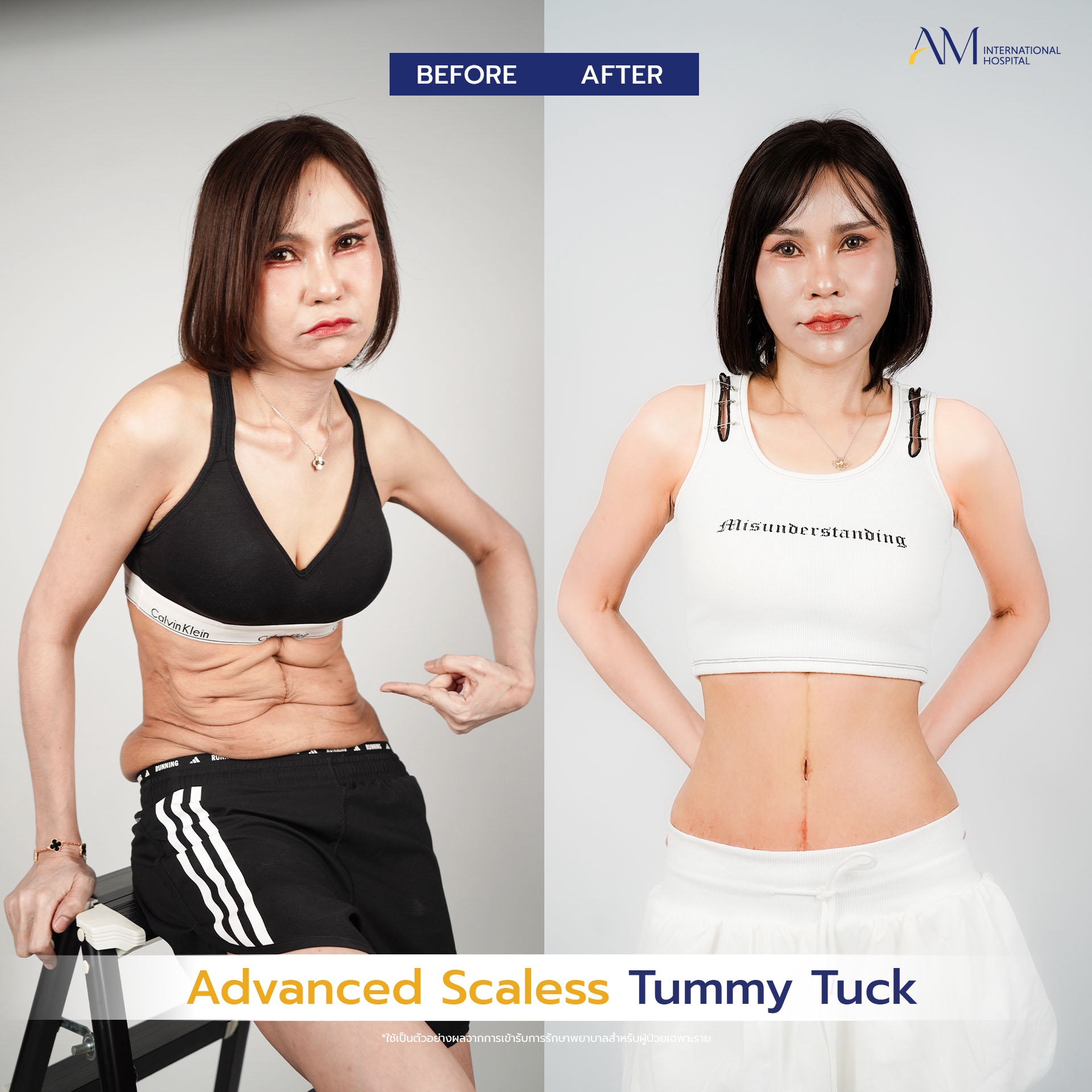 20250619-consi-single-BA_Line_Tummy Tuck 2025(แบบไม่มีแสง)-07