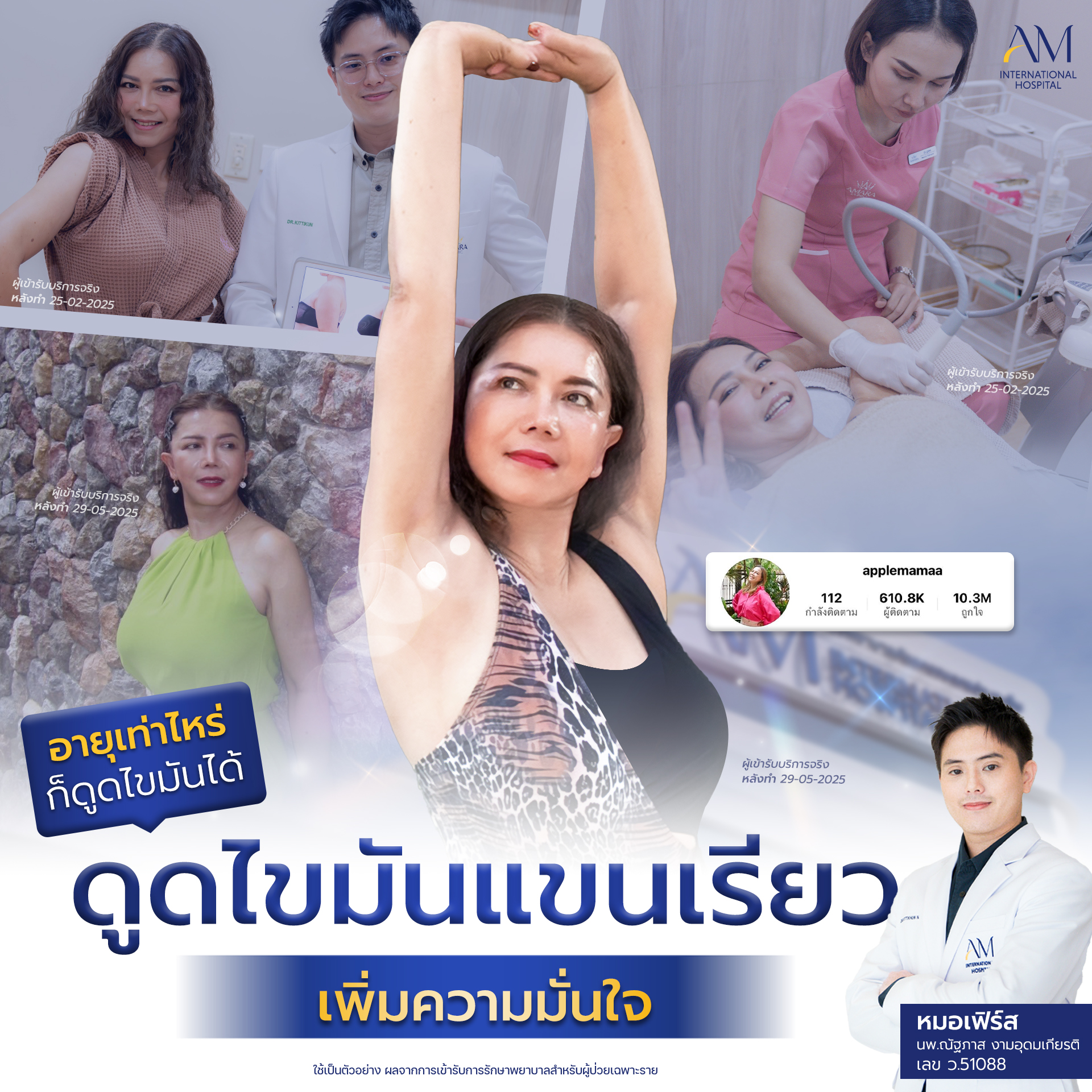 20250703-Aware-Single-ดูดไขมันแชน-15180