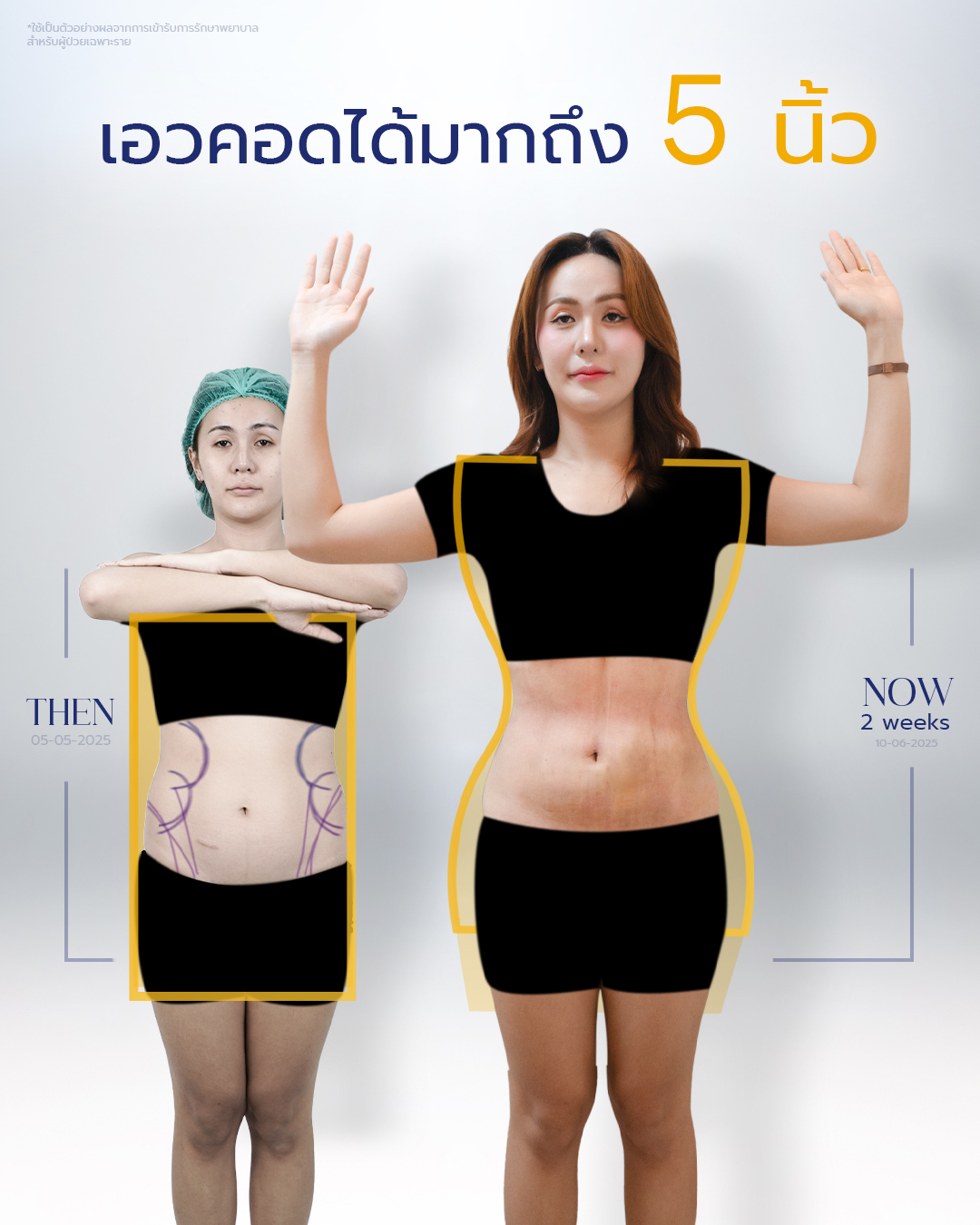 20250703-aware-Album-17152 คุณนิวเยียร์ Rib Remodeling #1-2
