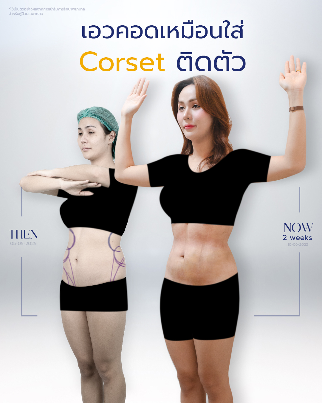 20250703-aware-Album-17152 คุณนิวเยียร์ Rib Remodeling #1-3