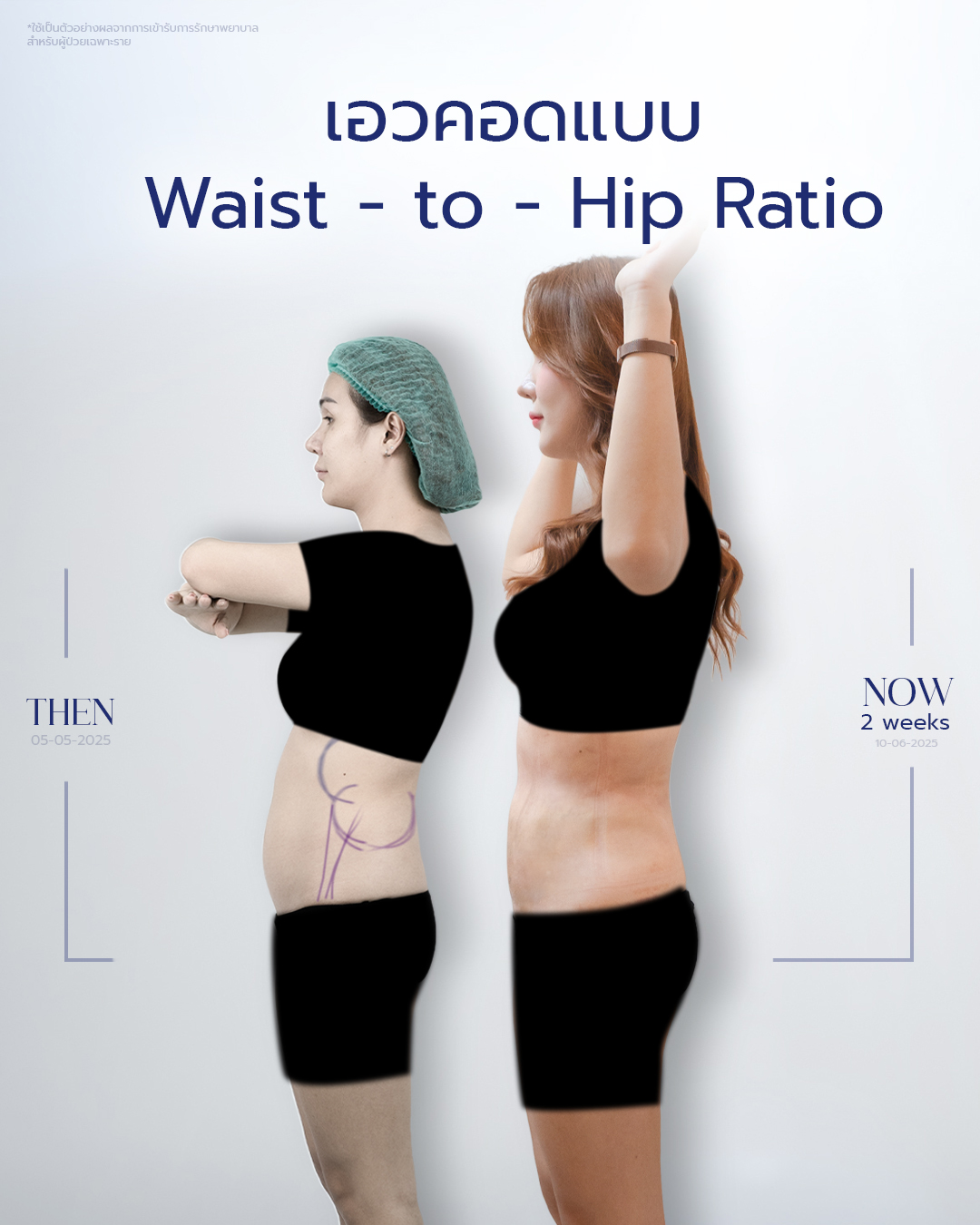 20250703-aware-Album-17152 คุณนิวเยียร์ Rib Remodeling #1-4