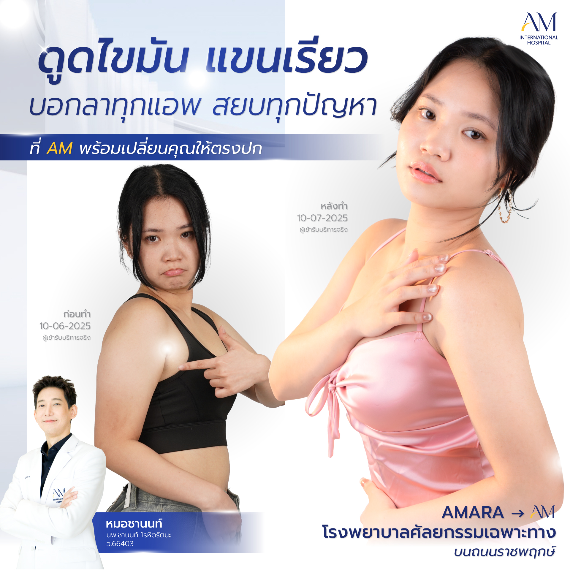 20250717-awareness-single-ดูดไขมันแขน-6320