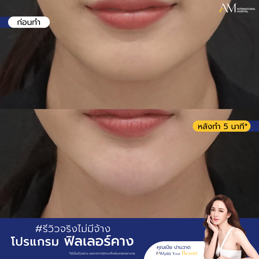BA ฟิลเลอร์คาง_ฟิลเลอร์คาง-01