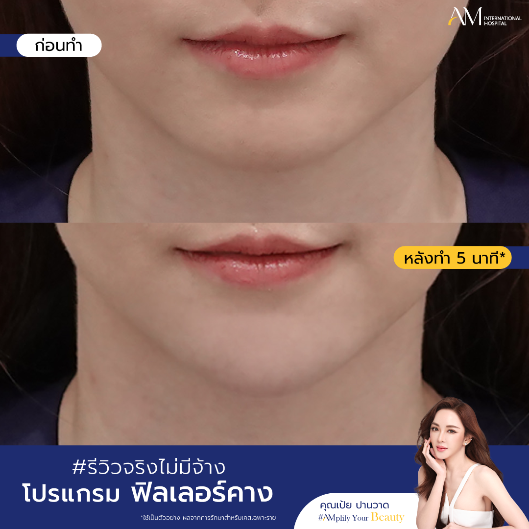 BA ฟิลเลอร์คาง_ฟิลเลอร์คาง-03