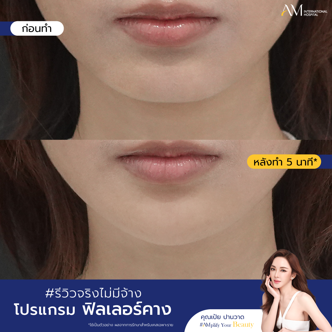 BA ฟิลเลอร์คาง_ฟิลเลอร์คาง-04
