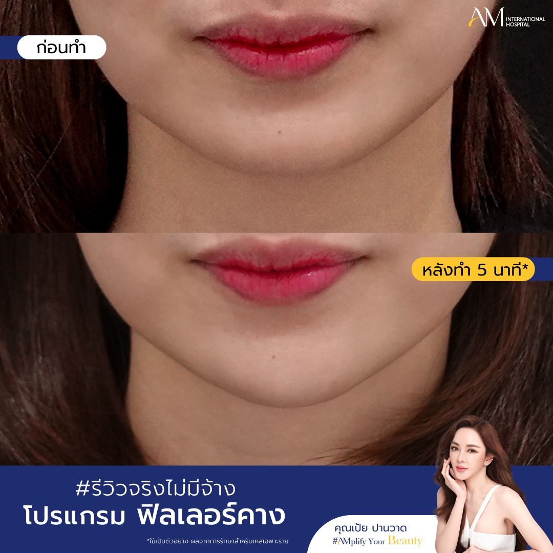 BA ฟิลเลอร์คาง_ฟิลเลอร์คาง-05