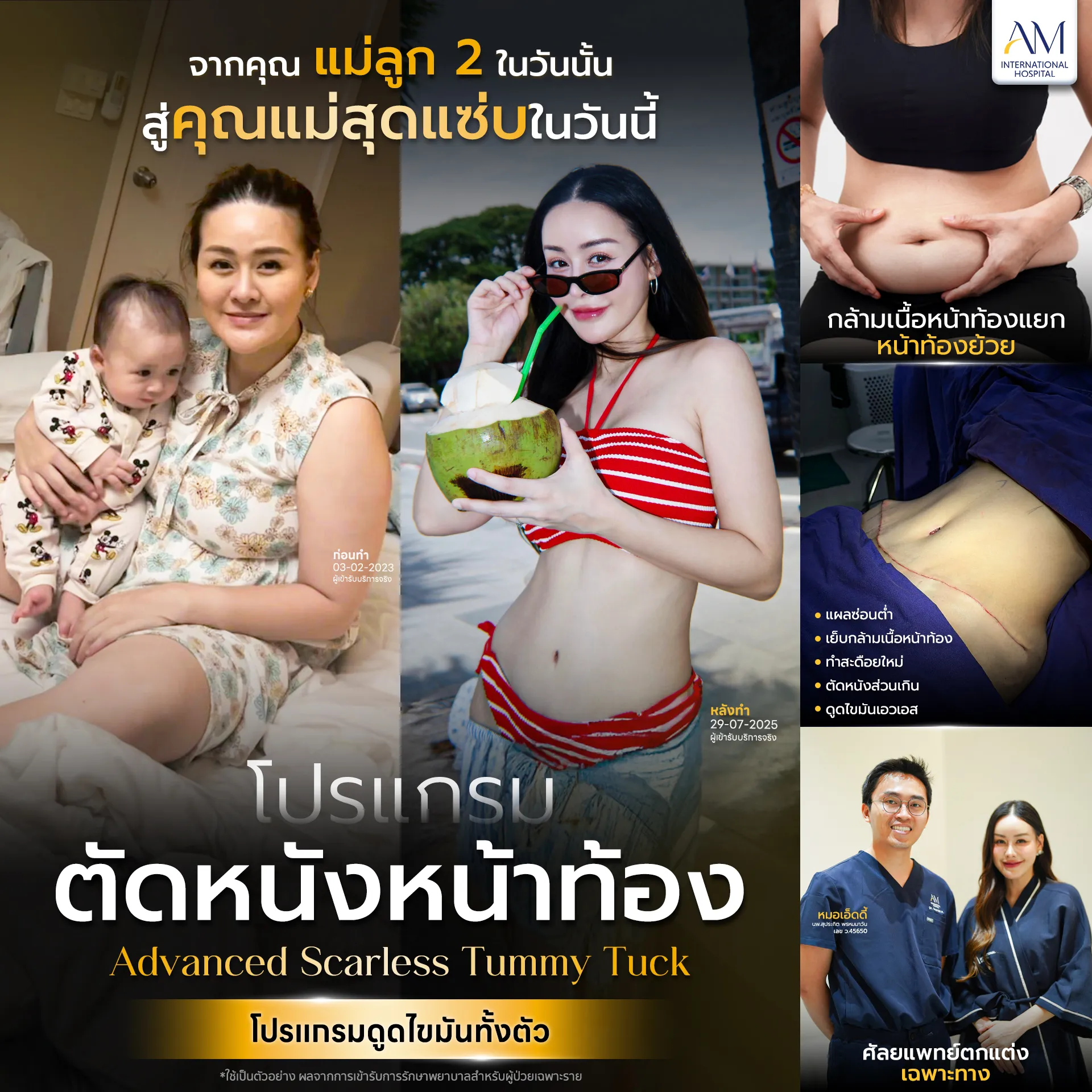 ตัดหนังหน้าท้อง รีวิว