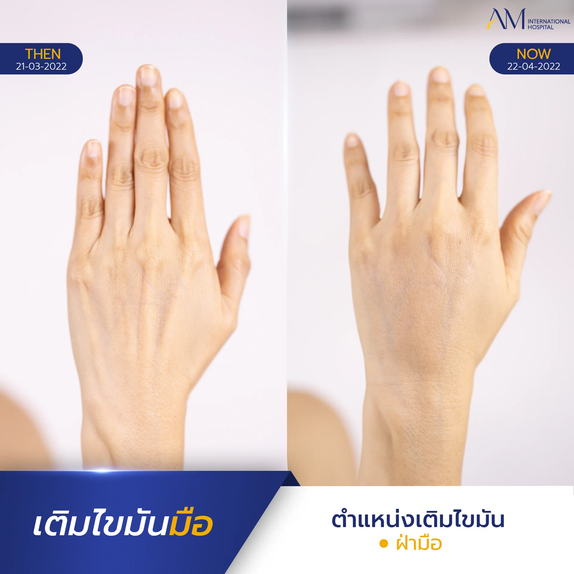 20250817-2025-08-15-AMINTER-BA-เติม-เติมมือ-2665