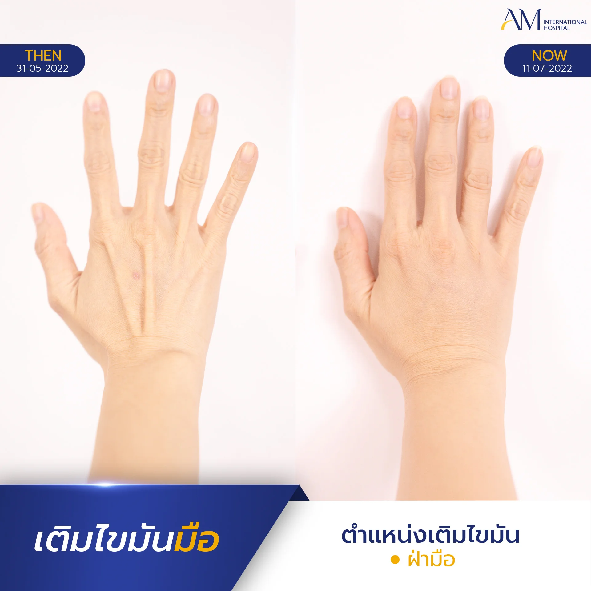 20250817-2025-08-15-AMINTER-BA-เติม-เติมมือ-4273