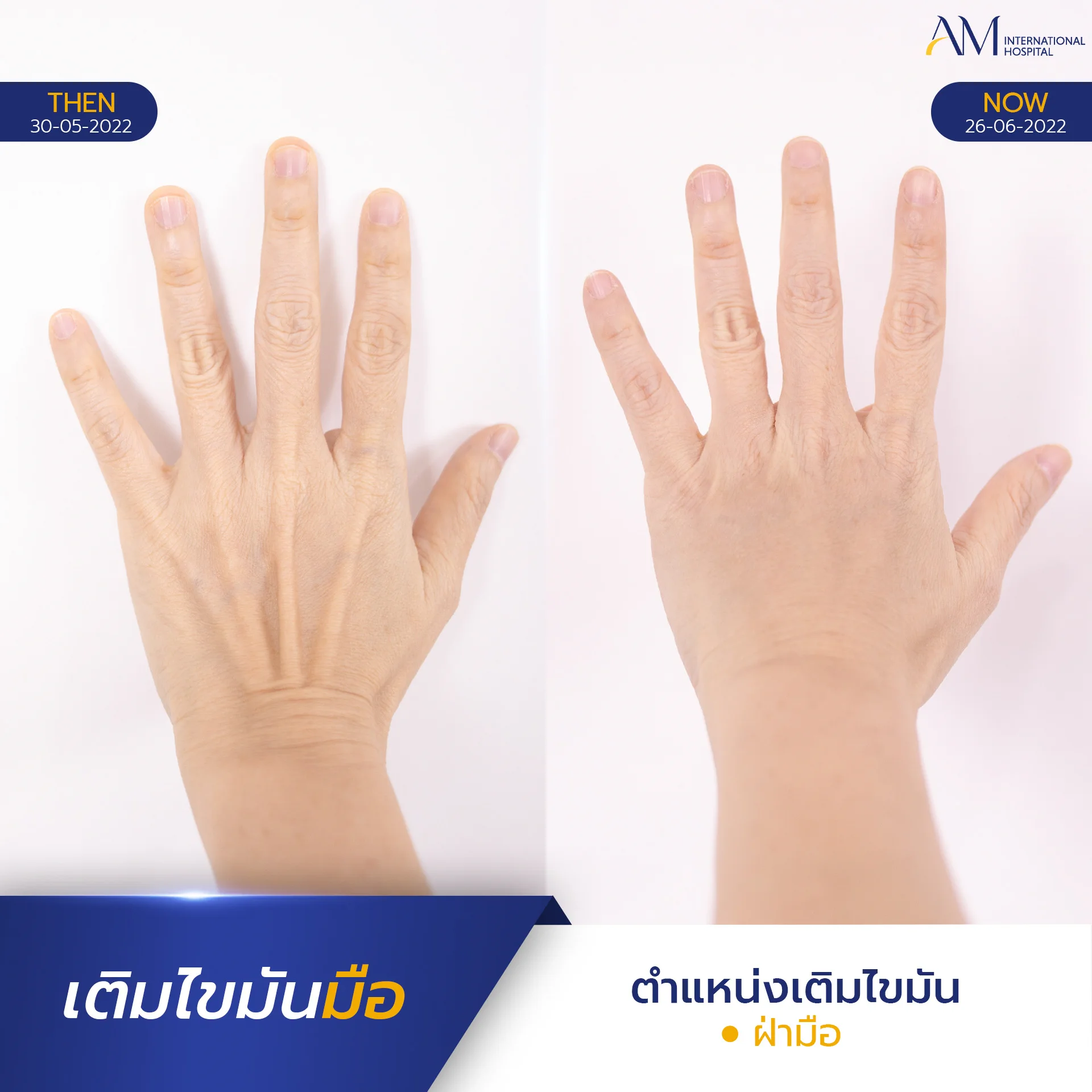 20250817-2025-08-15-AMINTER-BA-เติม-เติมมือ-4279