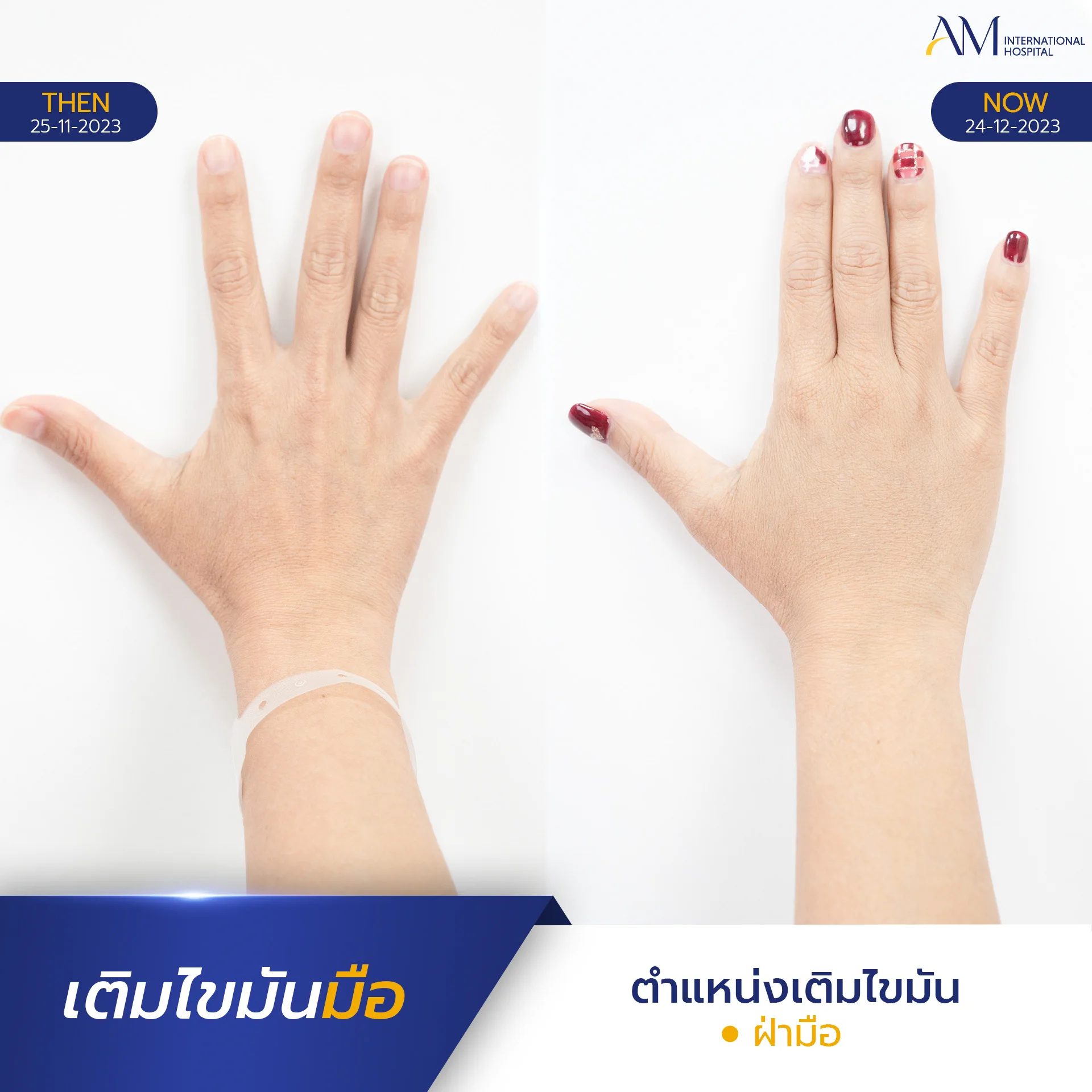 20250817-2025-08-15-AMINTER-BA-เติม-เติมมือ-9768