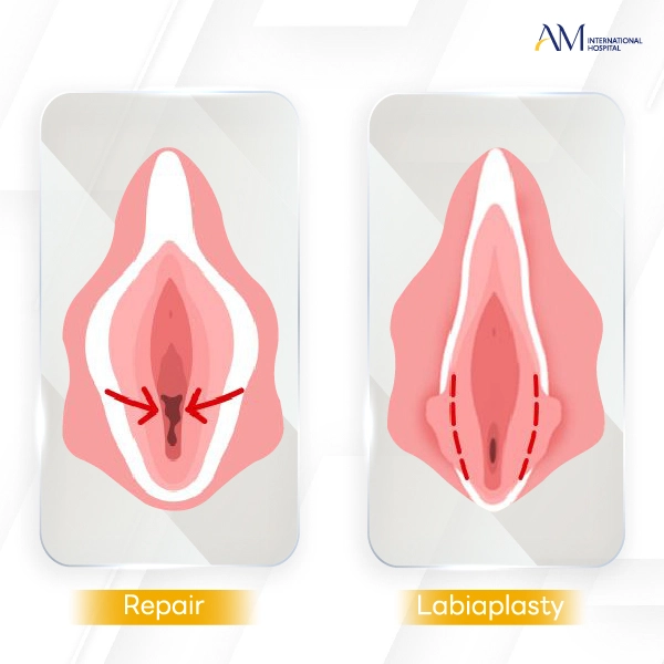 เลเบีย รีแพร์