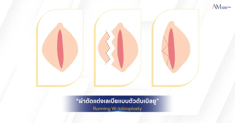 Running W Labiaplasty