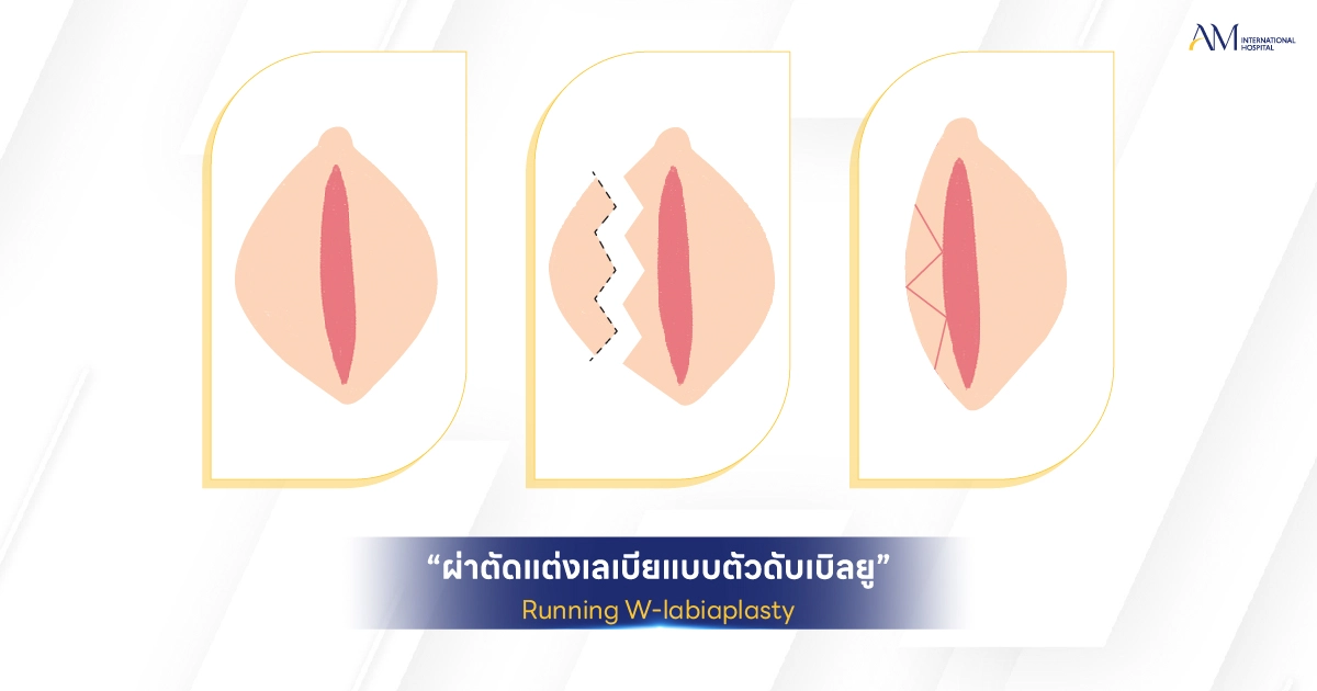 Running W Labiaplasty