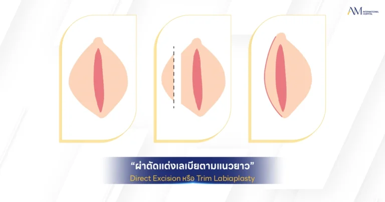 Trim Labiaplasty