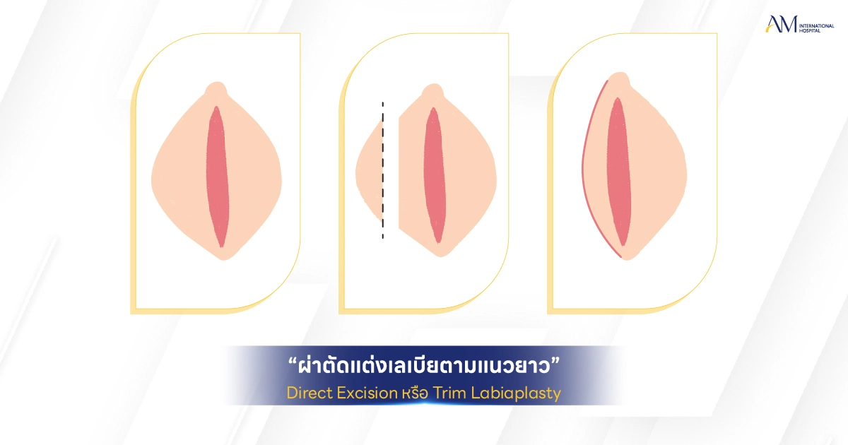 Trim Labiaplasty