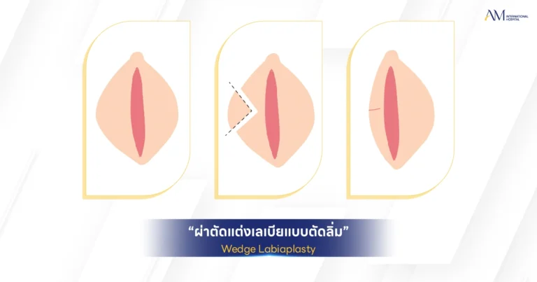 Wedge Labiaplasty