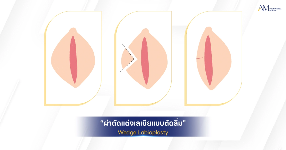Wedge Labiaplasty