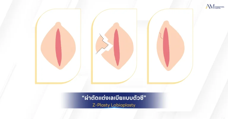 Z Plasty Labiaplasty