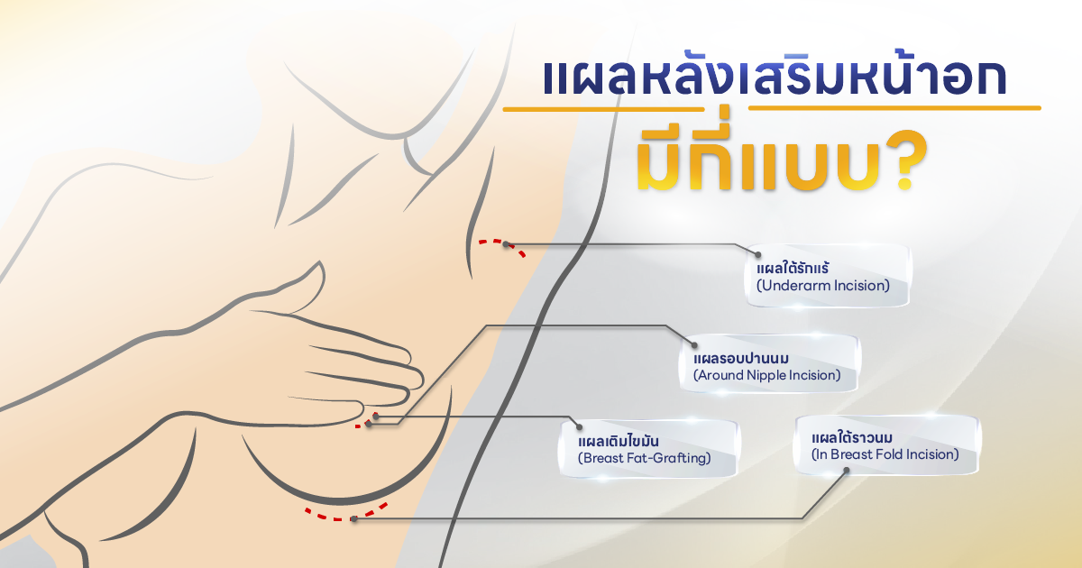 แผลหลังเสริมหน้าอก