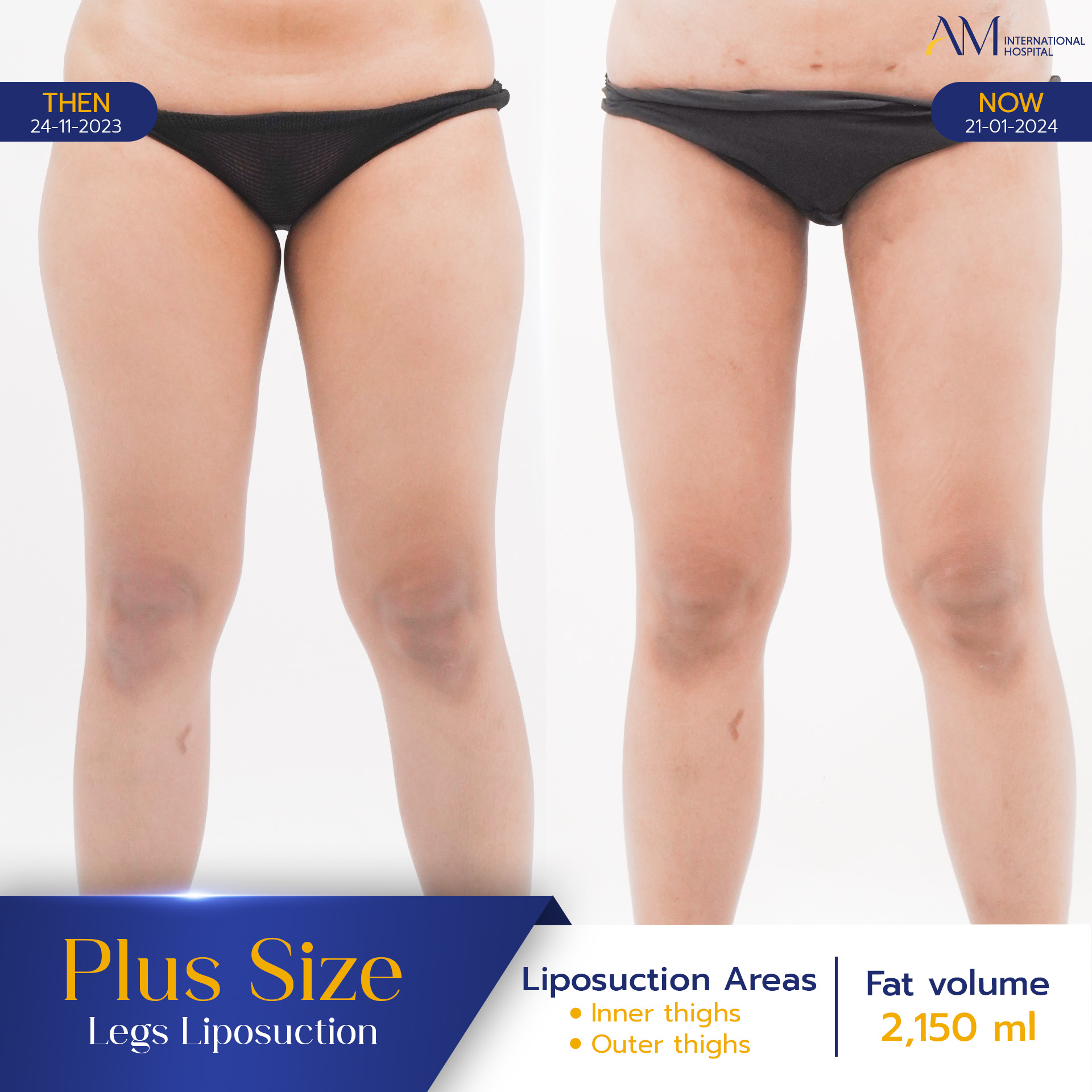 20250817-2025-08-15-AMINTER-BA-LIPO-Plus-ขา-11433