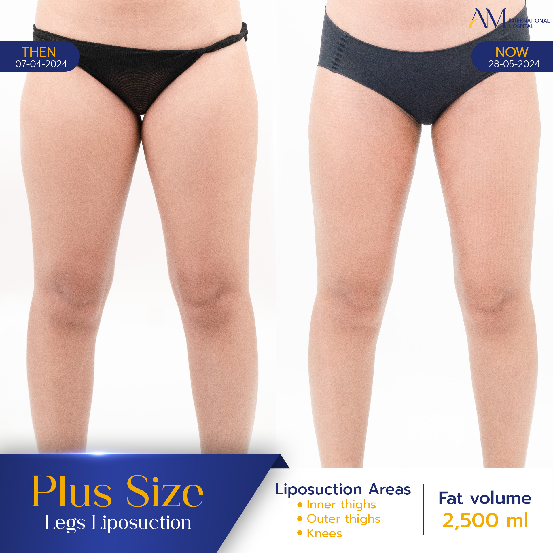 20250817-2025-08-15-AMINTER-BA-LIPO-Plus-ขา-13109