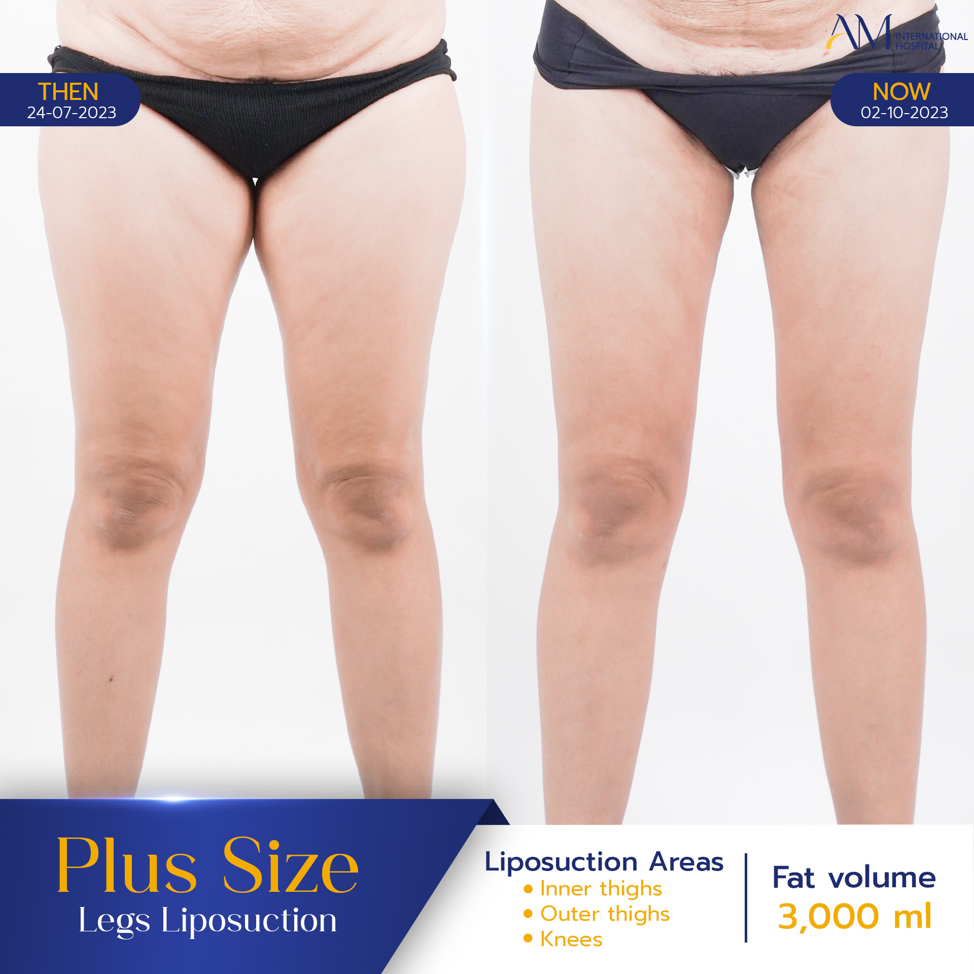 20250817-2025-08-15-AMINTER-BA-LIPO-Plus-ขา-4924