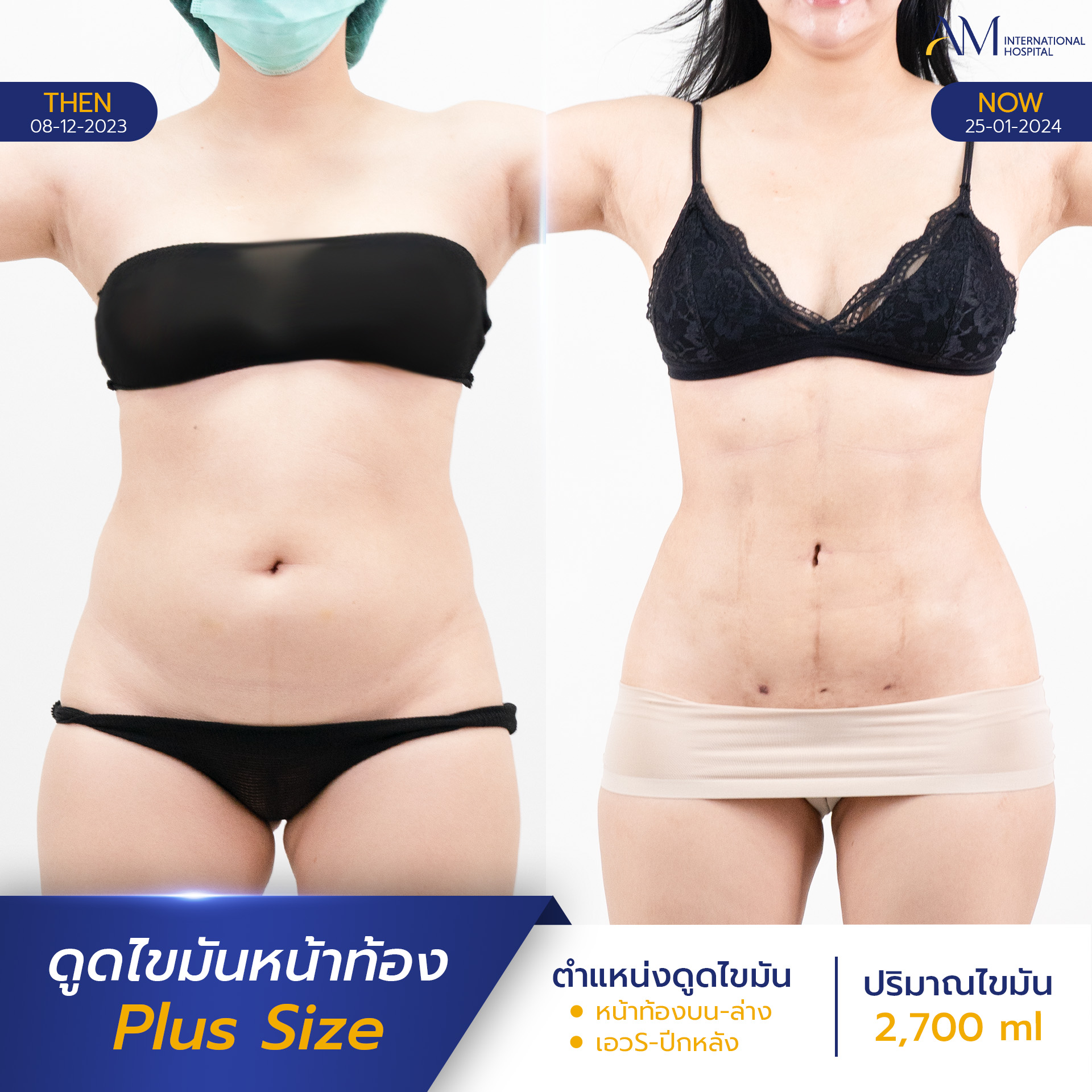 20250817-2025-08-15-AMINTER-BA-LIPO-Plus-ท้อง-11507
