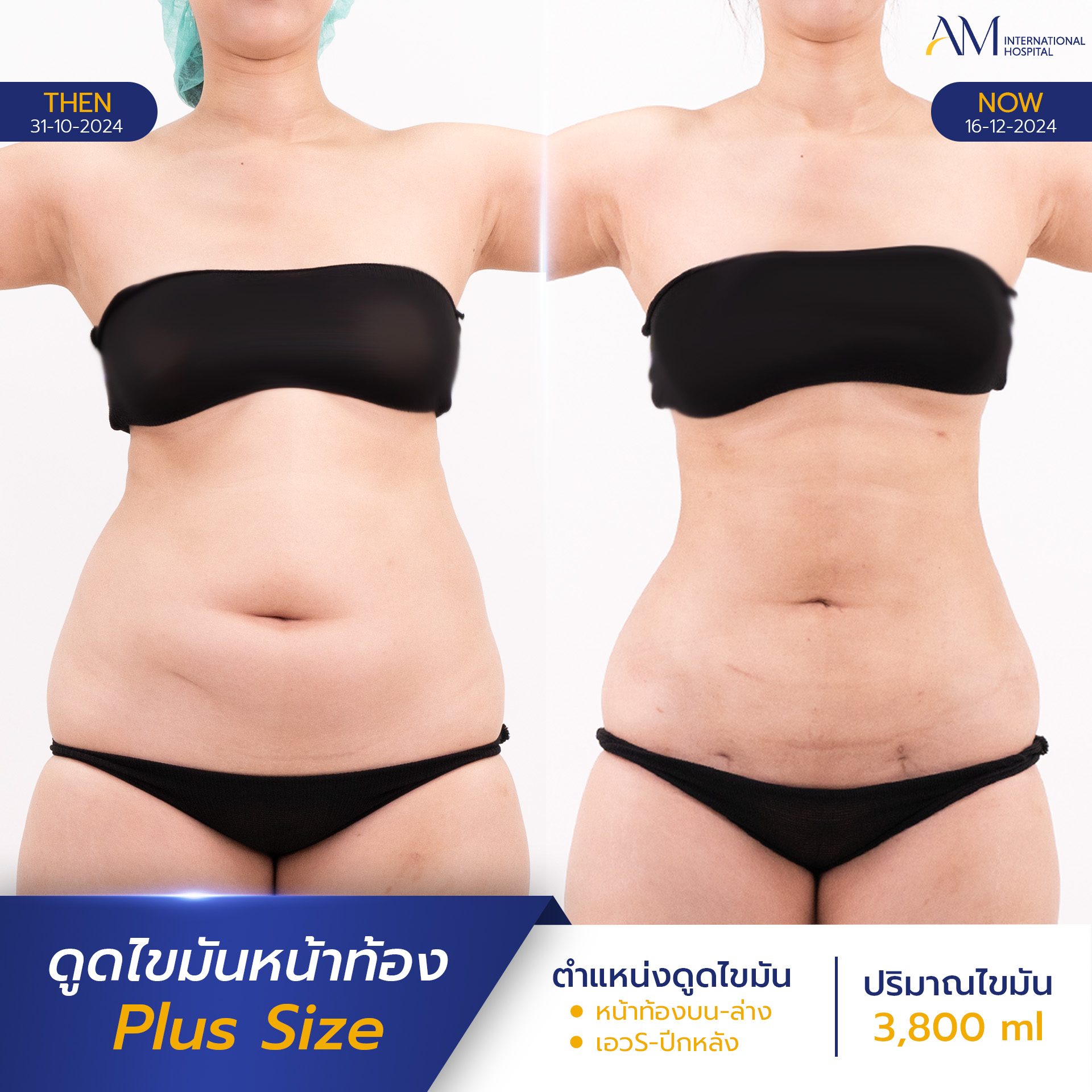 20250817-2025-08-15-AMINTER-BA-LIPO-Plus-ท้อง-7081