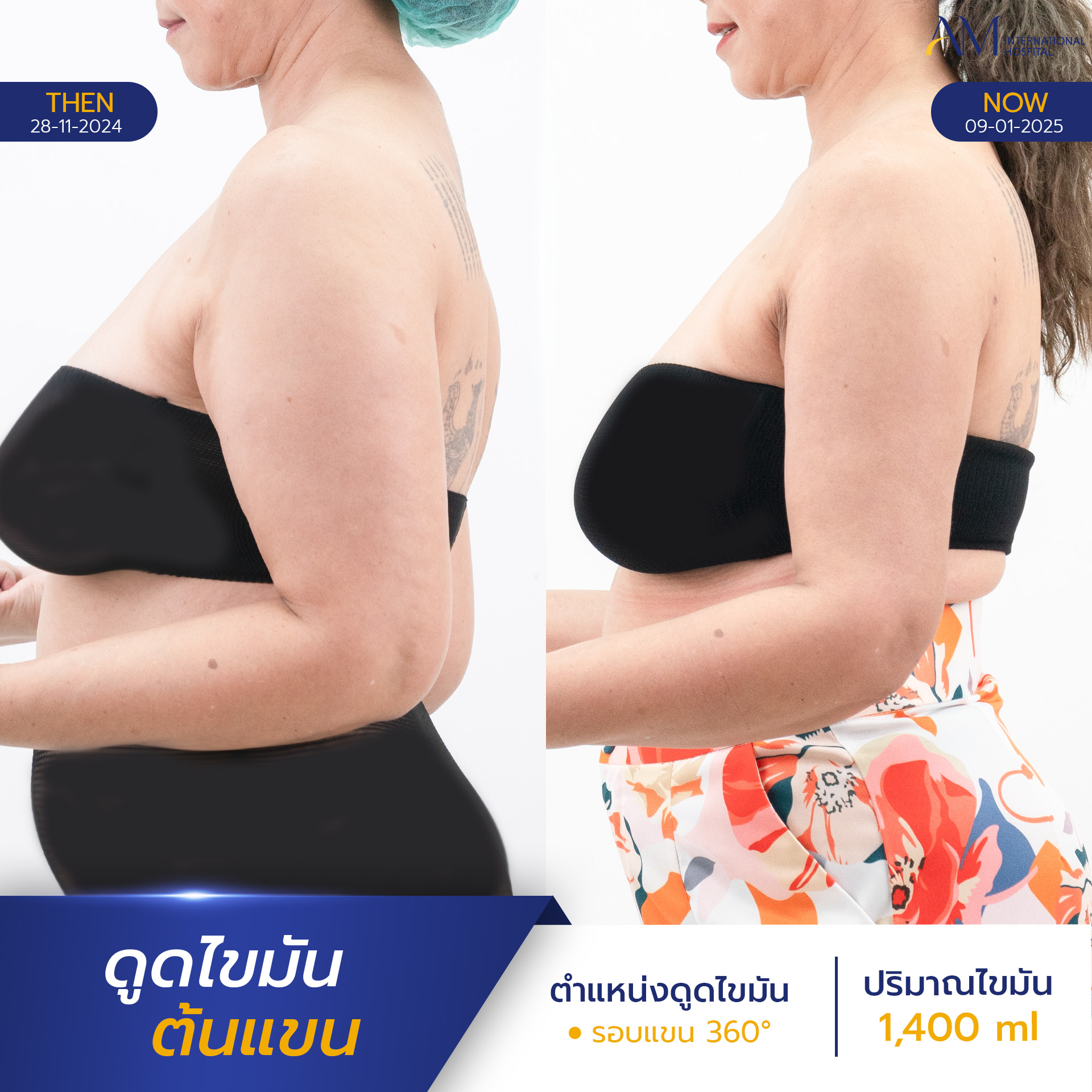 รีวิวดูดไขมันต้นแขน ที่ไหนดี
