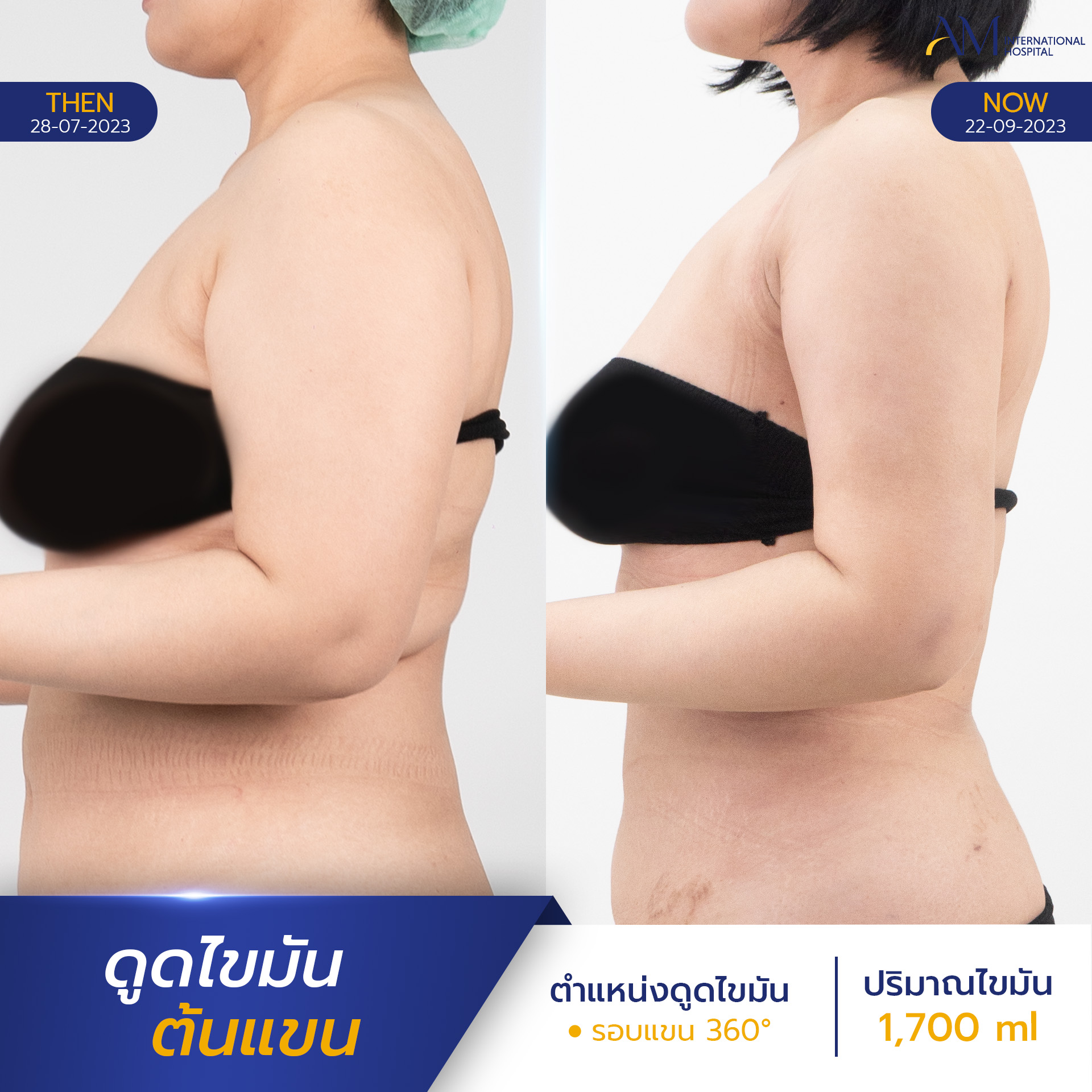 รีวิวดูดไขมันต้นแขน ลดสัดส่วน