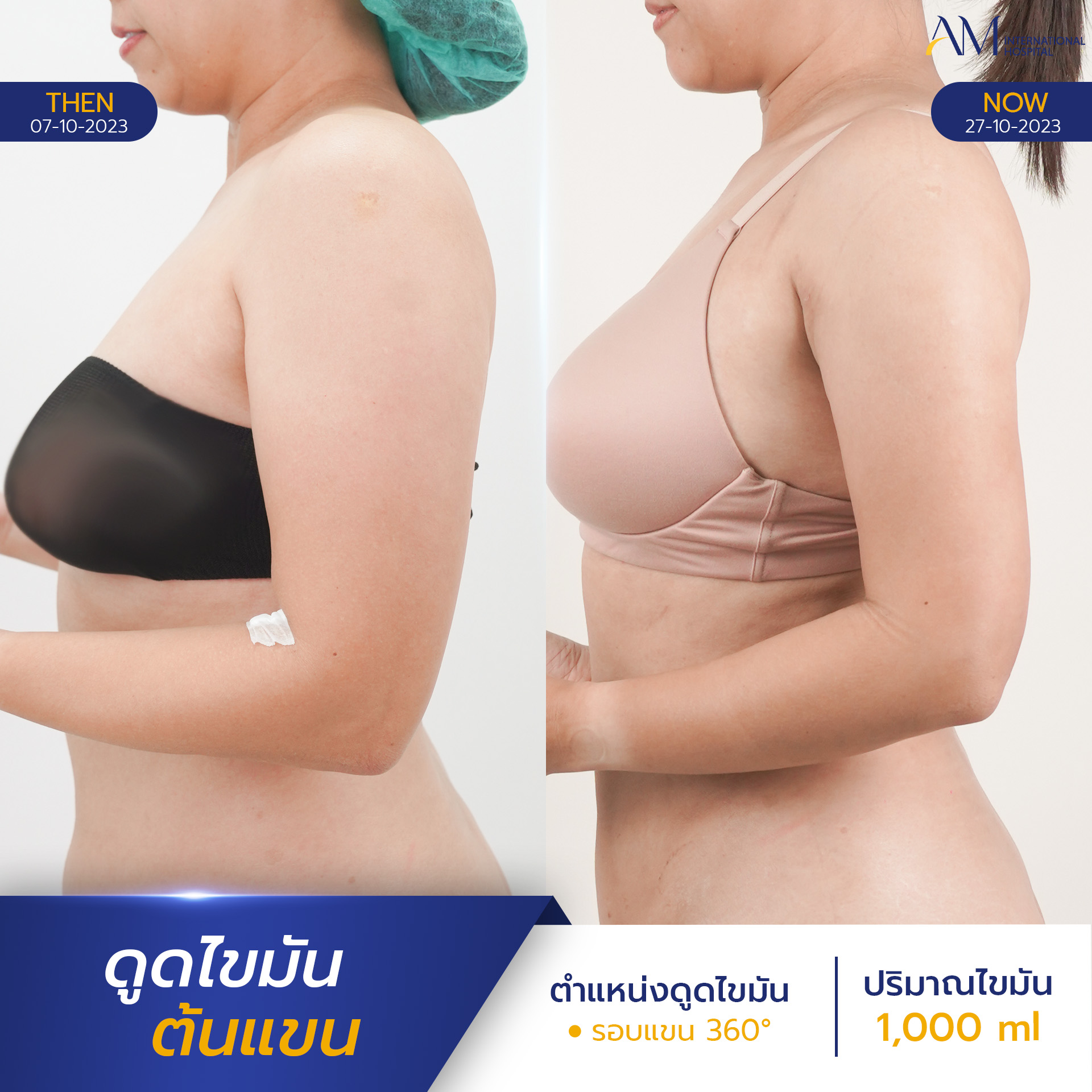รีวิวดูดไขมันต้นแขน สาวแขนใหญ่