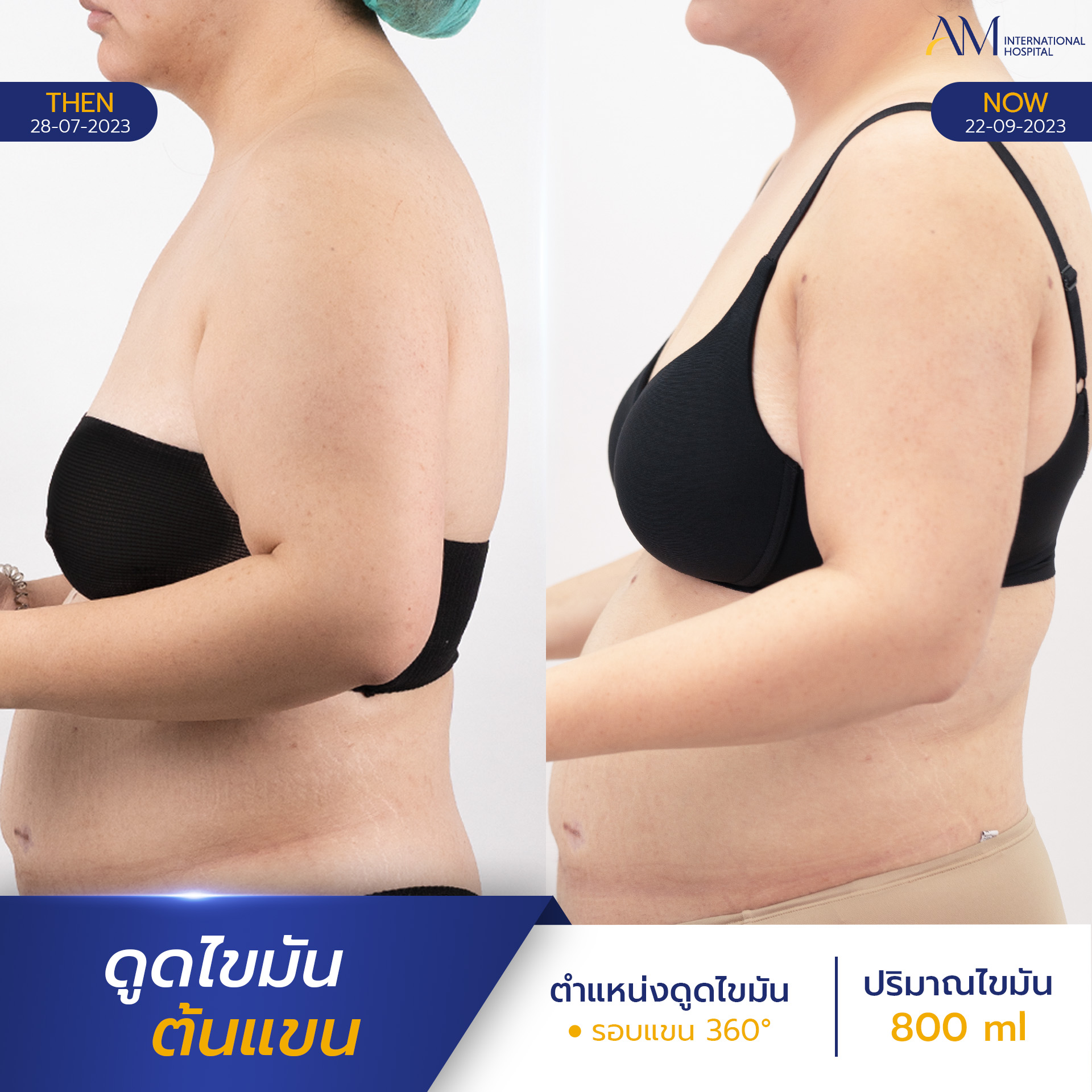 รีวิวดูดไขมันต้นแขน พักฟื้นนานแค่ไหน