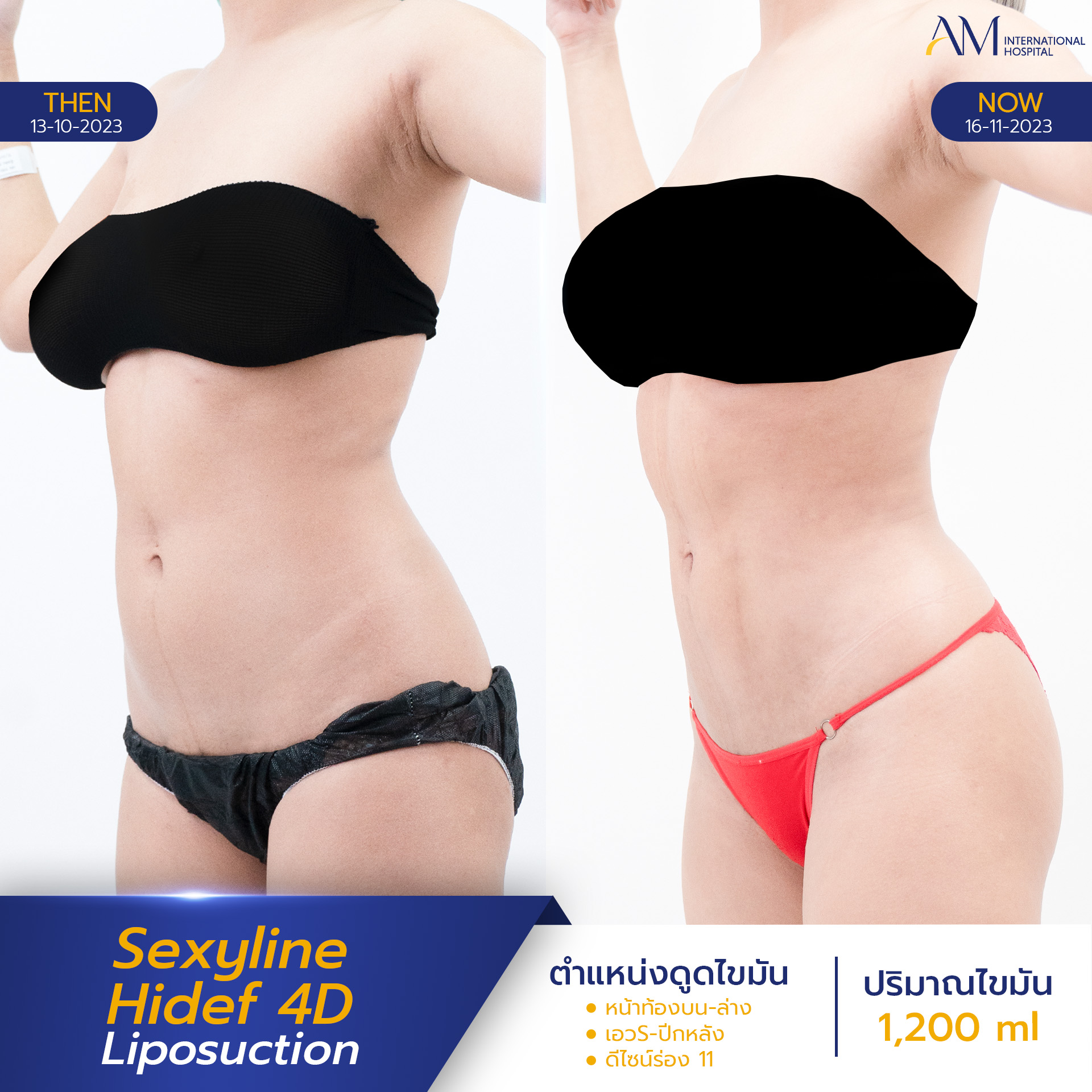 20250820-2025-08-18-AMINTER-BA-LIPO-Normal-Sexyline-11151