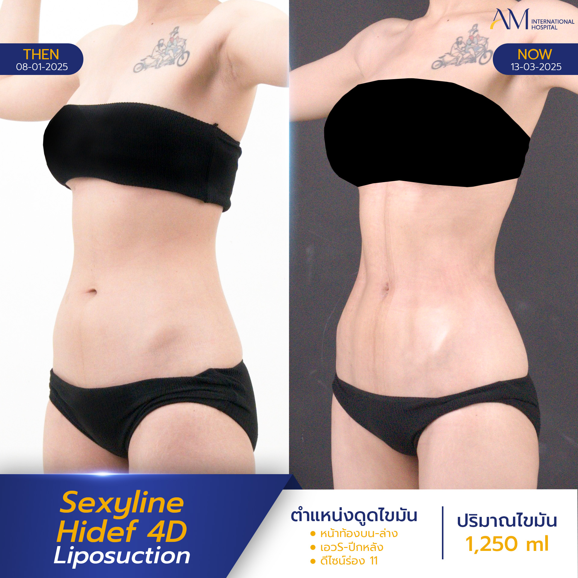 20250820-2025-08-18-AMINTER-BA-LIPO-Normal-Sexyline-13039