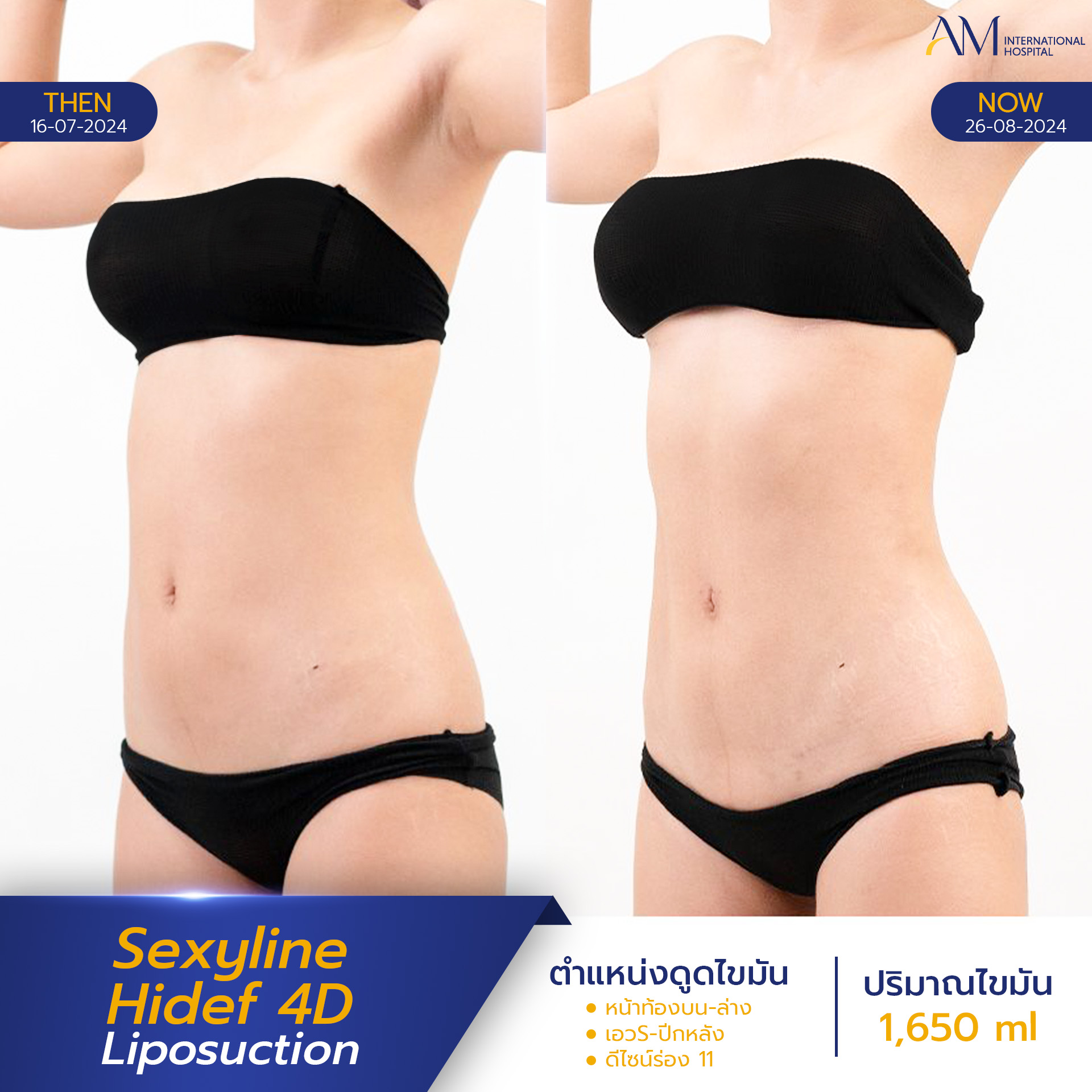 20250820-2025-08-18-AMINTER-BA-LIPO-Normal-Sexyline-13515