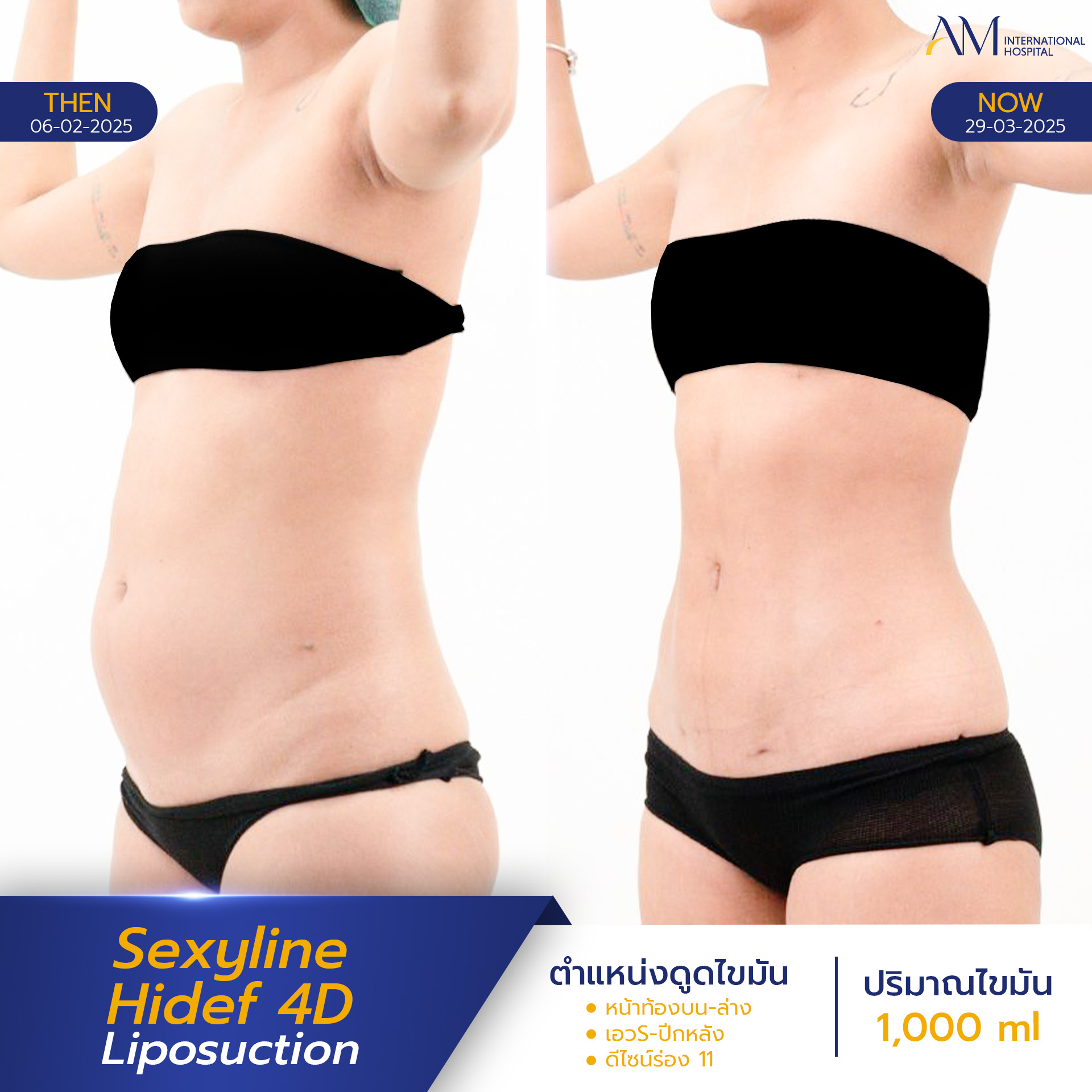 20250820-2025-08-18-AMINTER-BA-LIPO-Normal-Sexyline-9644