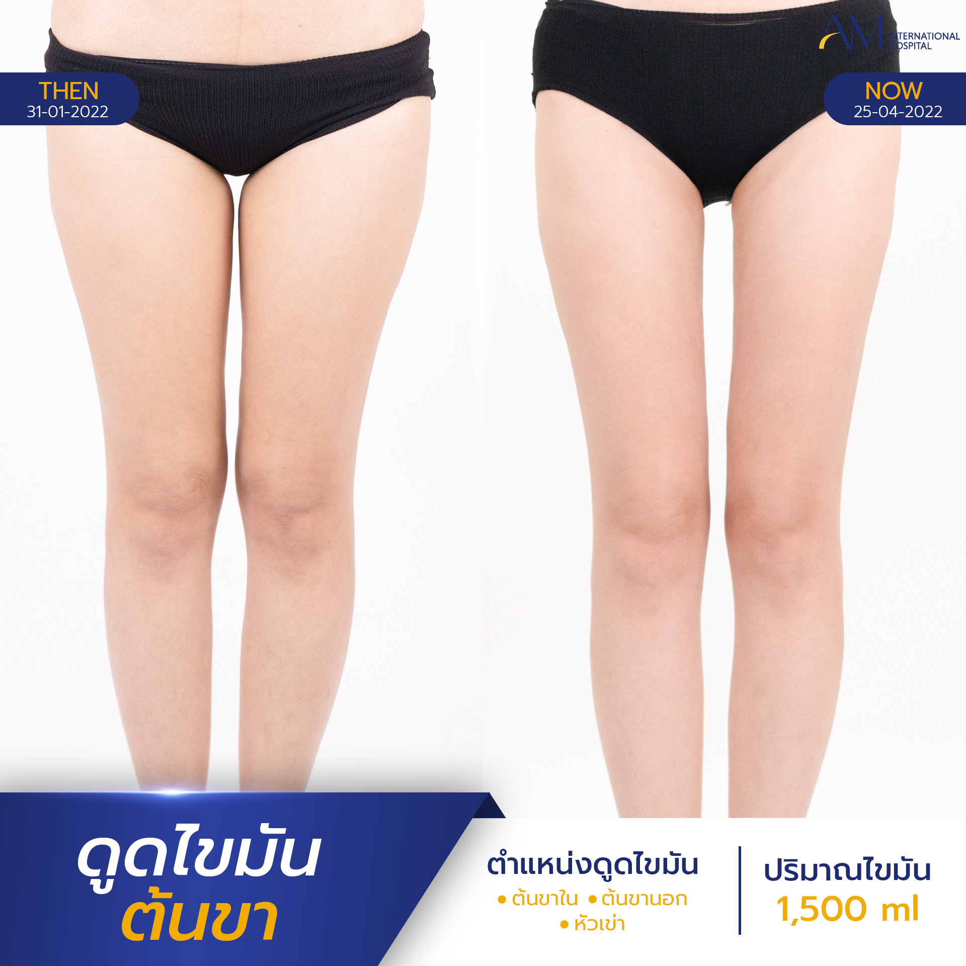 20250821-2025-08-18-AMINTER-BA-LIPO-Normal-ต้นขา-2995